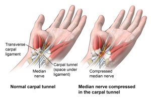 Anterior view of wrist comparing a healthy carpal tunnel with a compressed median nerve in the carpal tunnel; AMuscsk_20140312_v0_003; SOURCE: ortho_carp-tun-rel-endo_anat.ai; AMuscsk_20140312_v0_003_Layers.psd